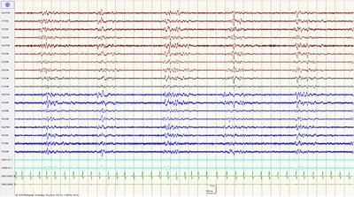 Coma With Absent Brainstem Reflexes and a Burst Suppression on EEG Secondary to Baclofen Toxicity